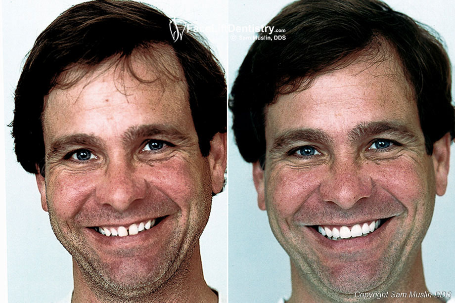 overbite veneers correction teeth fix bonding upper porcelain looks patient tmj complete treated ten tech ago had using