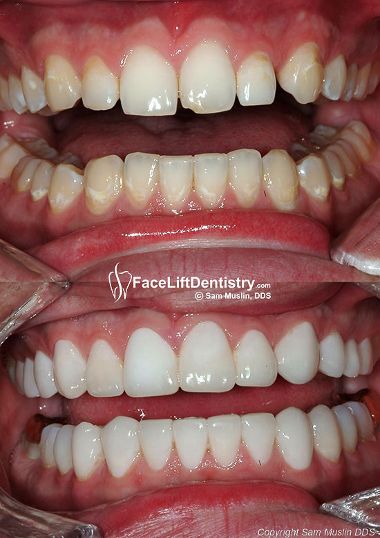  Closeup photo showing an overbite restored to a normal bite, done without braces.