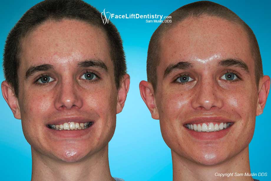 Overbite completely corrected without braces, no aligners, no drilling or grinding, in less than 4-weeks - Photos Before and After Correcting his Overbite.