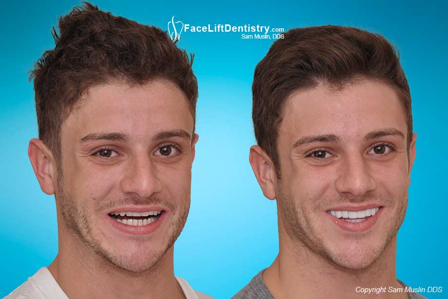 Overbite Correction without Invisalign Corrective Braces