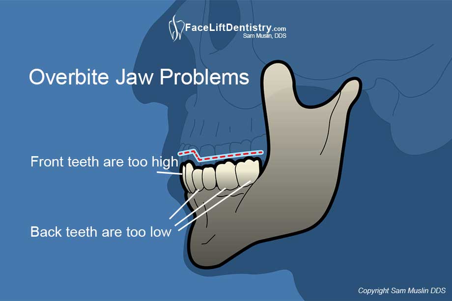 Illustration showing an overbite and resulting jaw tension