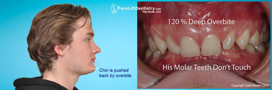 Deep Bite Problems - Jaw pushed back limiting tongue space