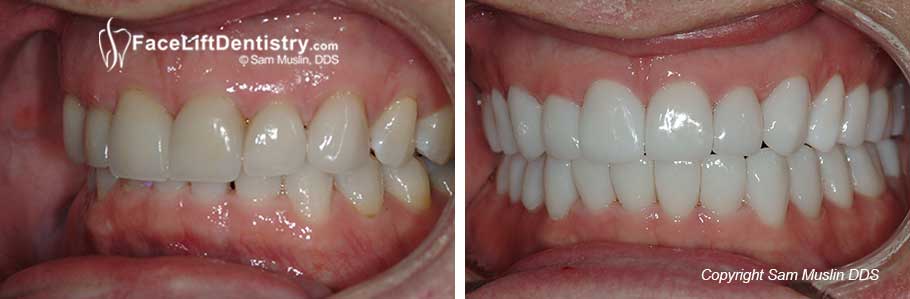 A closeup view of an overbite showing the overlap pushing the lower jaw back, resulting in a smaller looking chin.