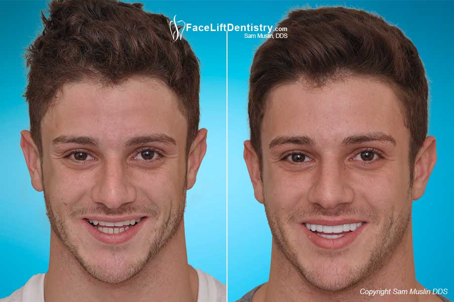 Overbite and TMJ Correction without Braces. Before and After Photo.