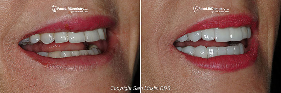 Under Bite correction with VENLAY<sup><sup>®</sup></sup> porcelain veneers and Face Lift Dentistry Treatment