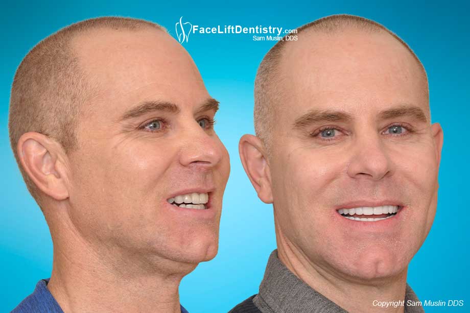 Porcelain veneers cannot fix an overbite as can be seen in the before photo. The after photo shows correction with VENLAY® Restorations.