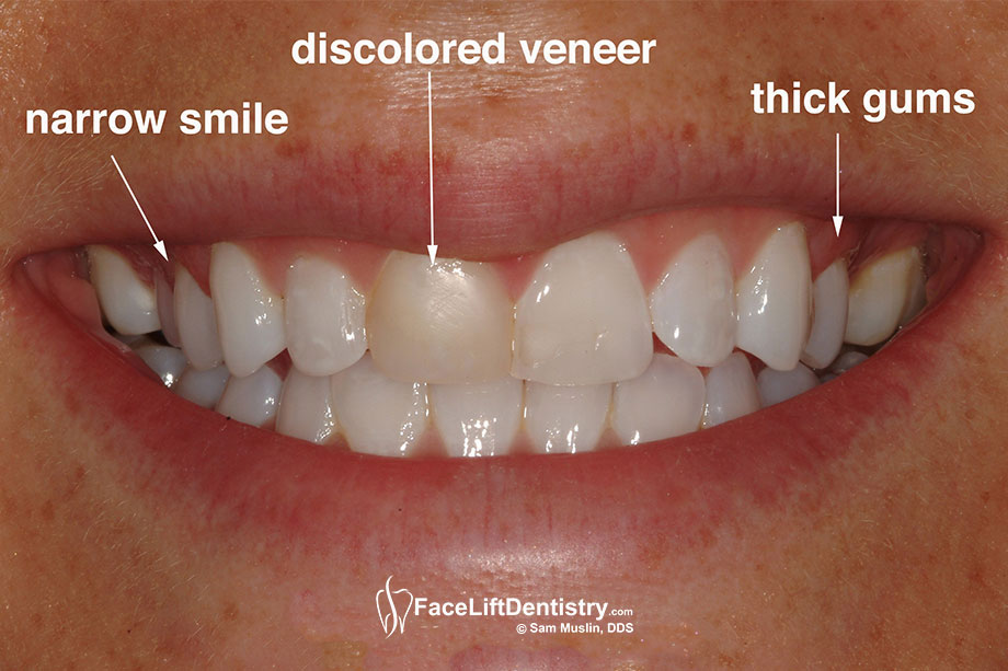 A close-up photo showing a bad discolored veneer, a narrow smaile and gum thickening.