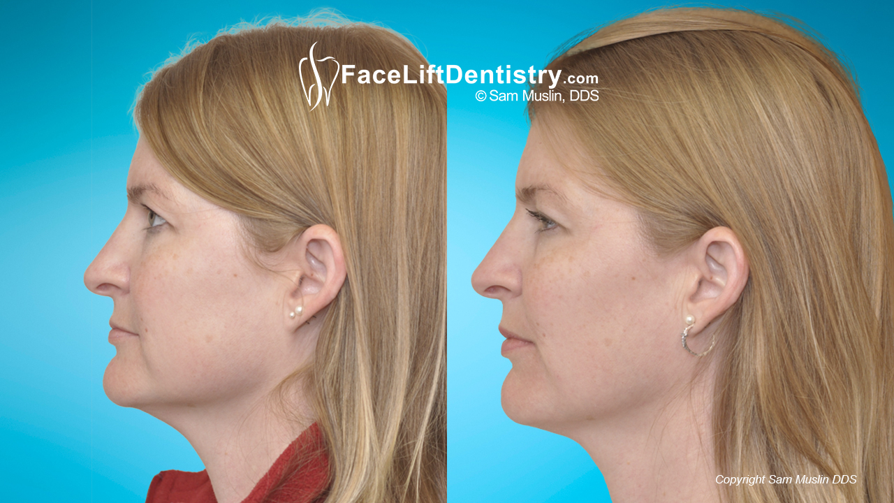 small teeth and overbite corrected for a better profile, before and after