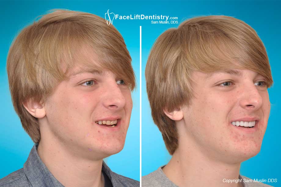 A patient with his teeth affected by Amelogenesis Imperfecta as well as an open bite