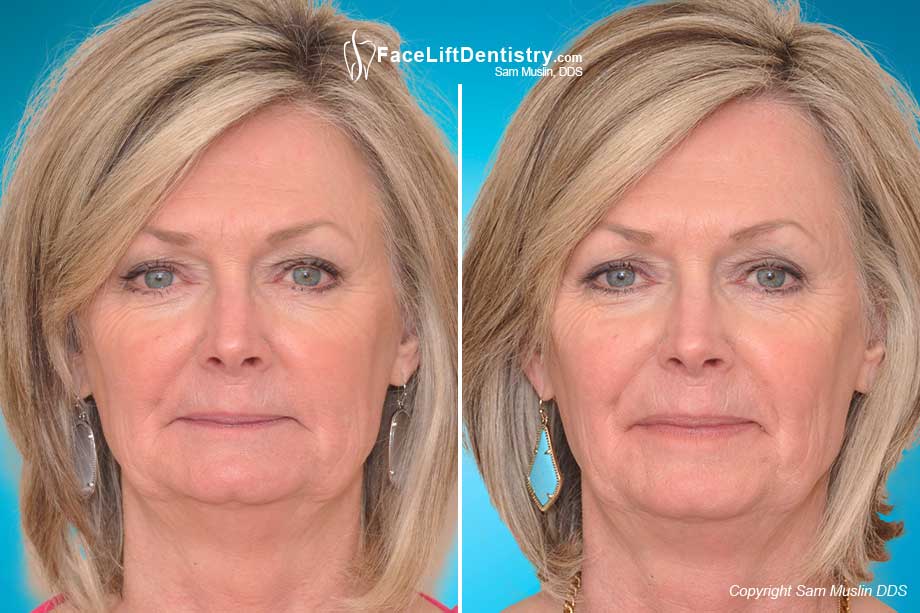 The aging effects of an overbite, seen in a before-and-after treatment photo.