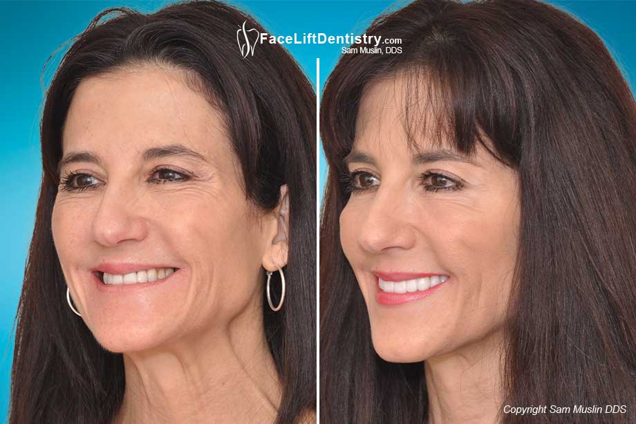 Total Facial Optimization with Face Lift Dentiostry