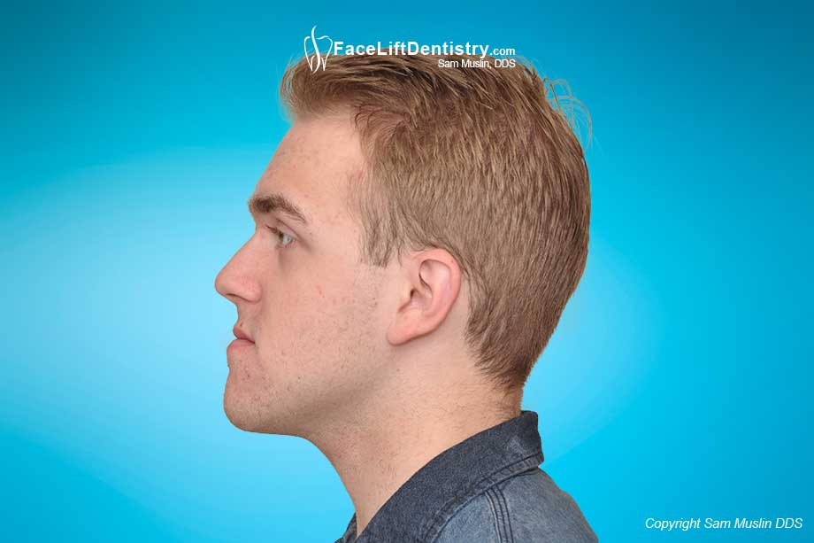 Facial profile of adult with a protrusive chin.