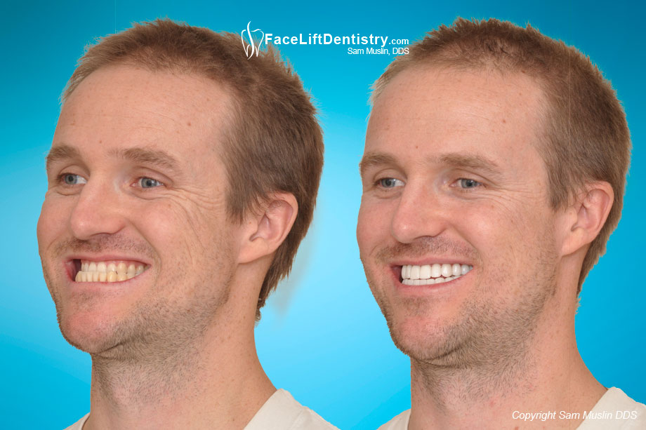 Patient with a protruding large lower jaw, before and after treatment