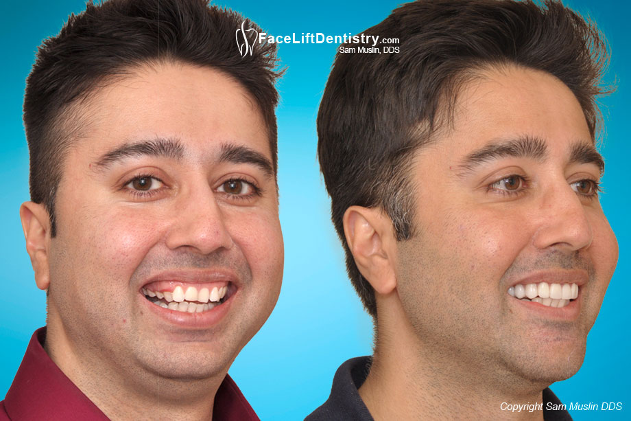 Before and After jaw alignment and small chin fixed.