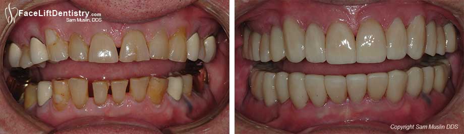 A closeup view of aging teeth and restored teeth