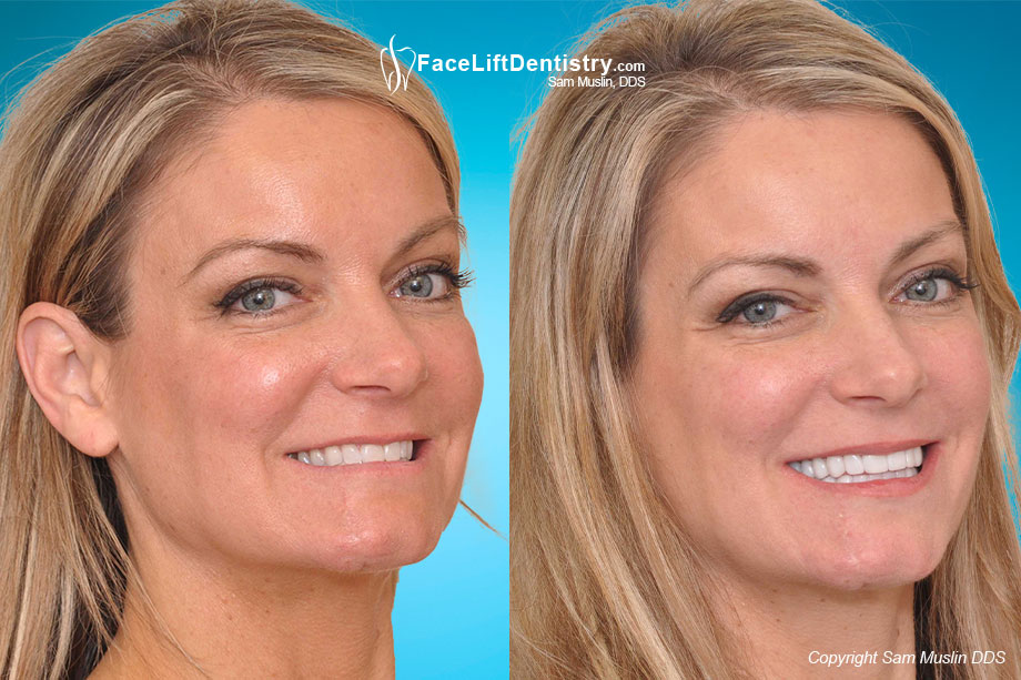 Reversing the Aging Process with Face Lift Dentistry - Before and After Treatment