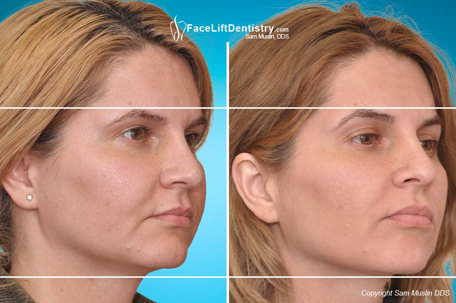 The Shape of the Face Changed  with VENLAY<sup><sup>®</sup></sup> porcelain veneers and Face Lift Dentistry Treatment