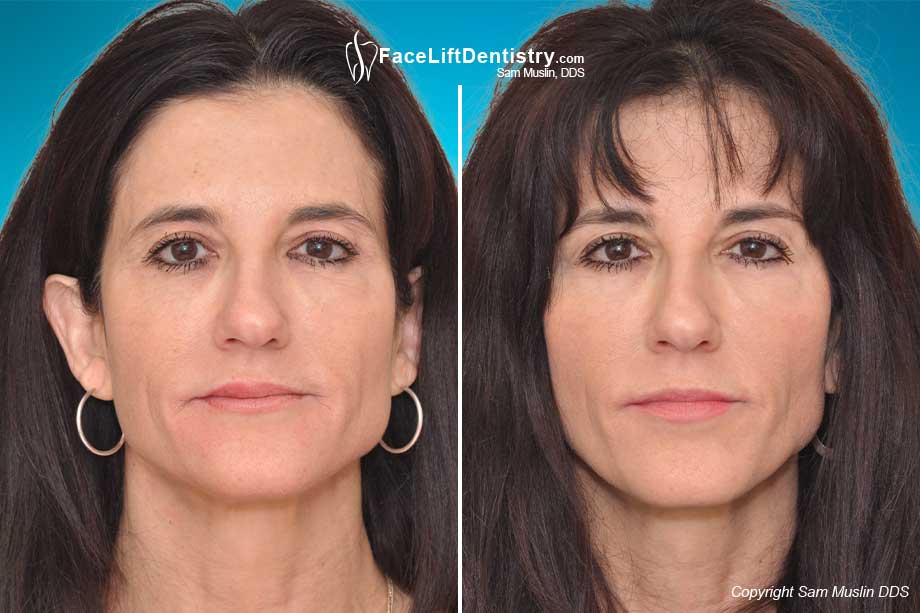 how to change your face shape without surgery