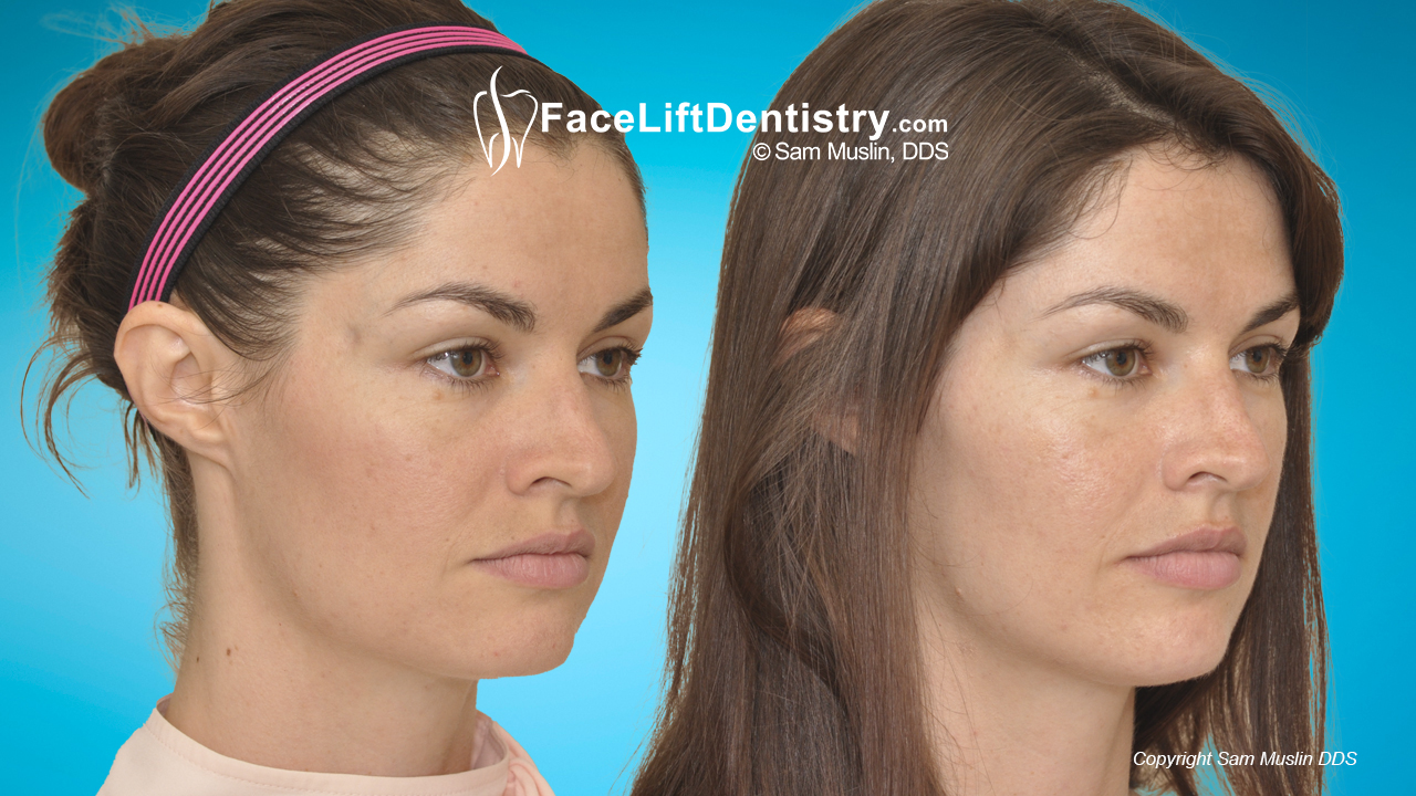 facial profile correction, before and after treatment with facelift dentistry