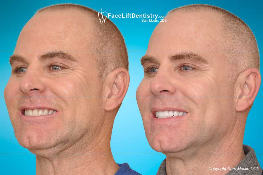 Short face and small chin corrected with JawTrac® and VENLAY® - before and after treatment photos.
