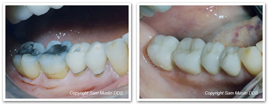 Silver Fillings and Porcelain Crowns - CLose-up Photo