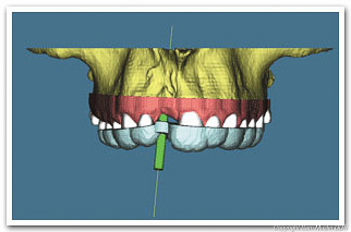 A diagram showing the placement of a single dental implant.