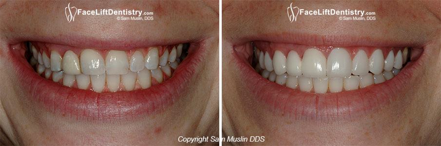 Slanted smile correction closeup - before and after