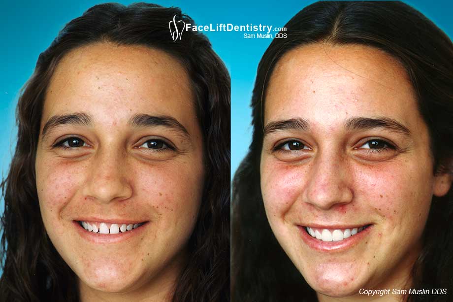 Photo showing the before and after of an adult with small short teeth, treated with non-invasive poercelain veneers.