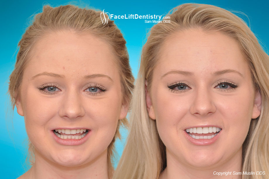  The photo on the left shows worn yellow crooked teeth and an overbite. In the after photo on the right the entire face shows the outcome of treating her bite with Face Lift Dentistry®.