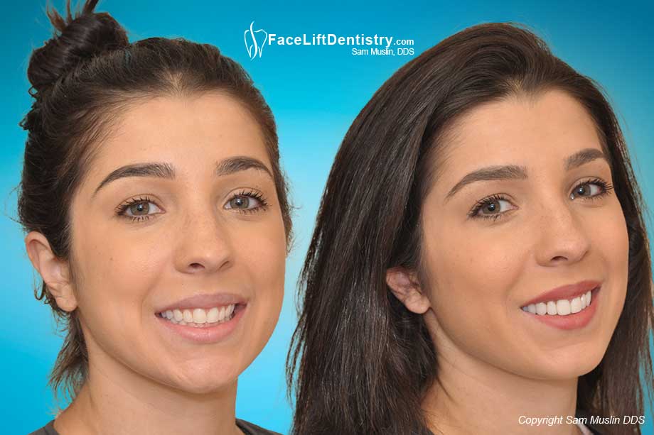 Patient with small teeth and recessive chin, before and after treatment...