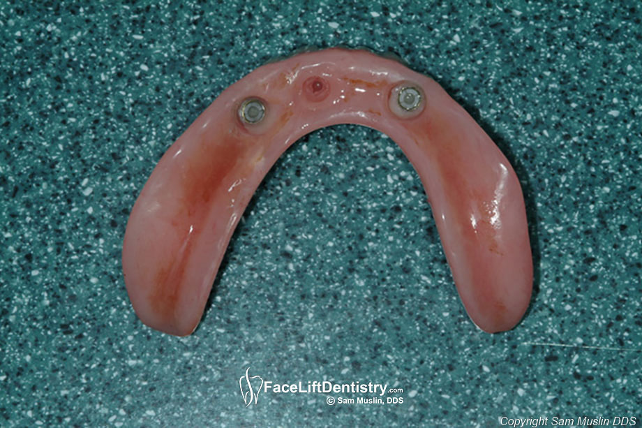  Snap-in Dentures