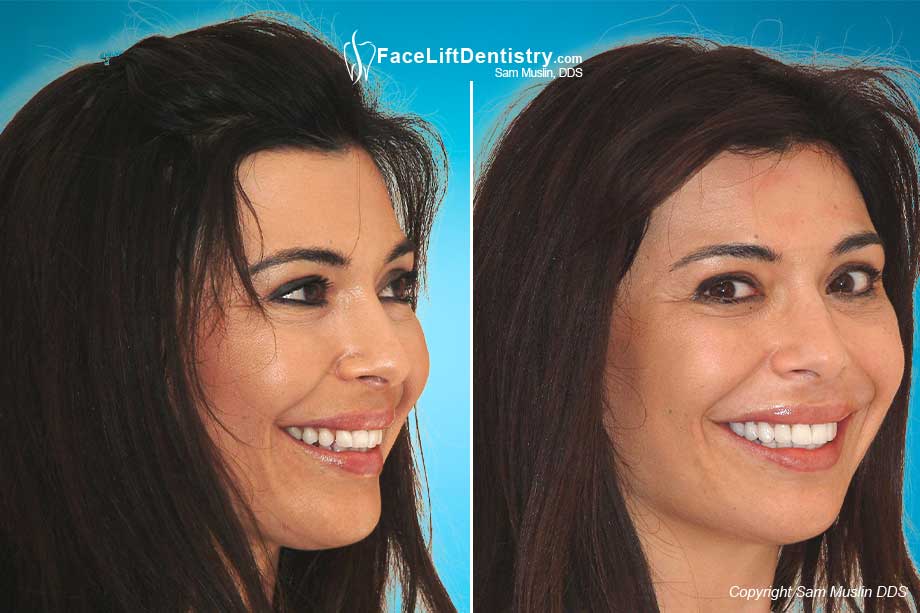  Before and after photo showing how the gaps in her teeth and crooked lateral incisors were treated with prepless veneers.