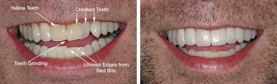 How To Fix Crooked Teeth Without Braces At Home - Homemade ...