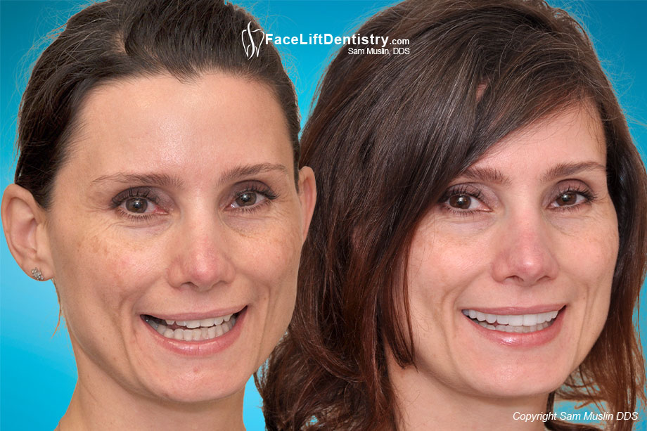 Before treatment  photo showing a woman with jaw stress and a bad bite and a relaxed jaw and corrected bite with no tension and stress in the After treatment photo.