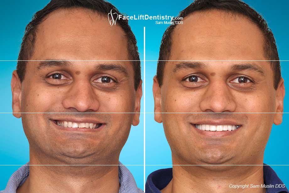 Before and After Deep Overbite Correction without Aligners, Braces or Surgery