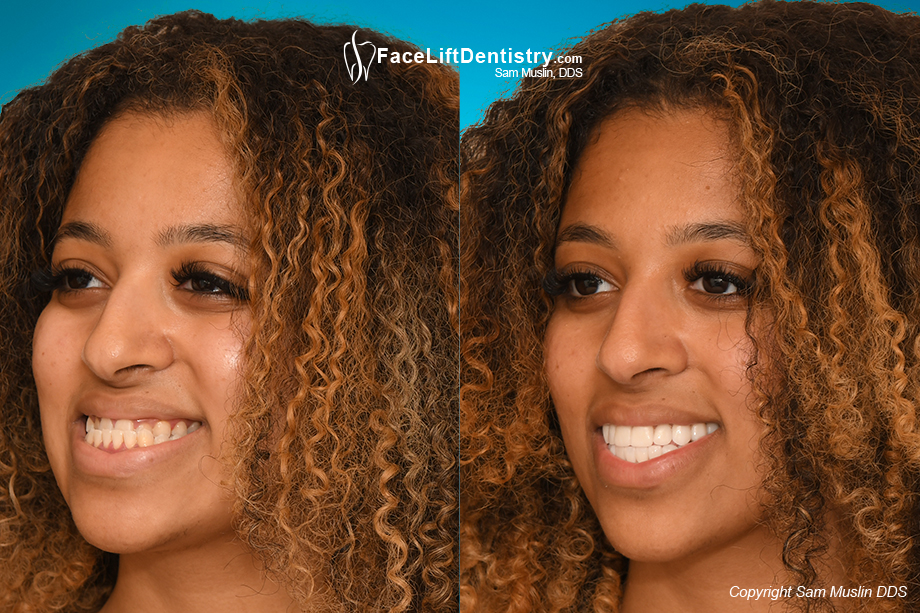 Misaligned Teeth and Jaw Corrected - Before and After