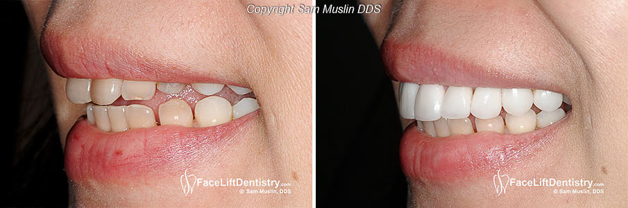  The before and after photo shows Tetracycline stains treated with Noninvasive Porcelain Veneers