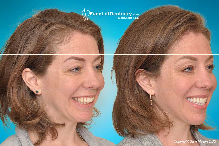 Moving the jaw into the final jaw position without surgery - before and after treatment