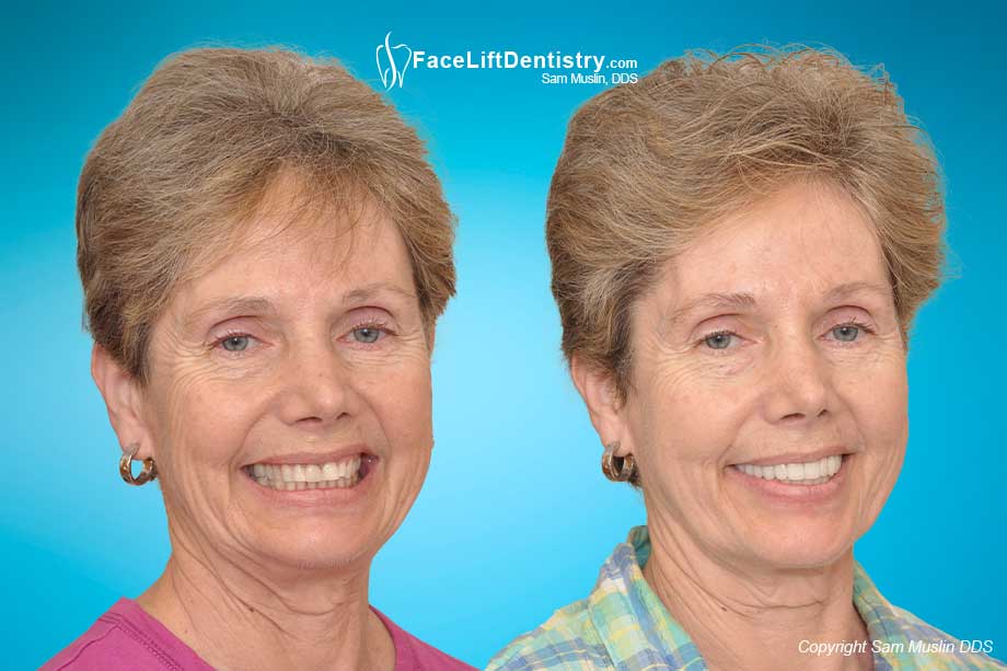 Before and After anti-aging Face Lift Dentiostry