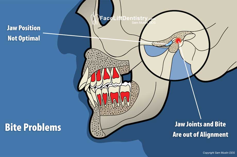 The TMJ with the jaw in a less than optimal position