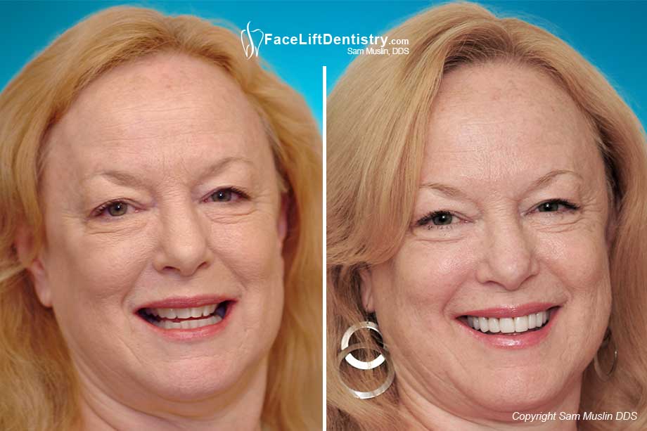  The photo on the left shows a strained and uncomfortable jaw position, leading to TMJ pain. After Face Lift Dentistry the photo on the right shows a relaxed and optimized jaw position which aleviated jaw TMJ jaw pain.