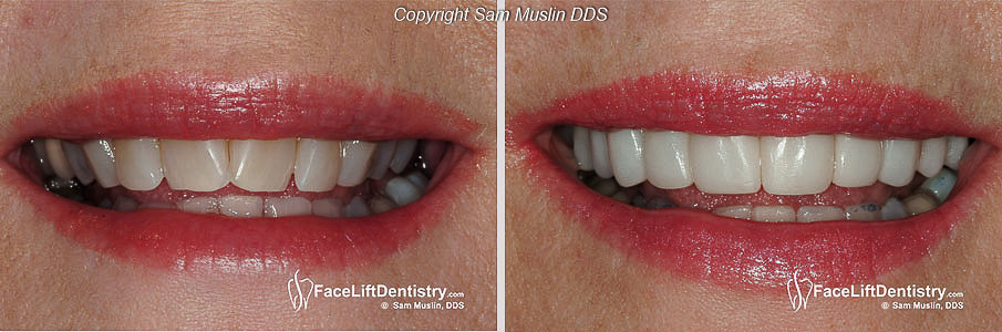  The before photo shows a narrow smile which is now corrected in the after photo for better facial support and less TMJ strain.