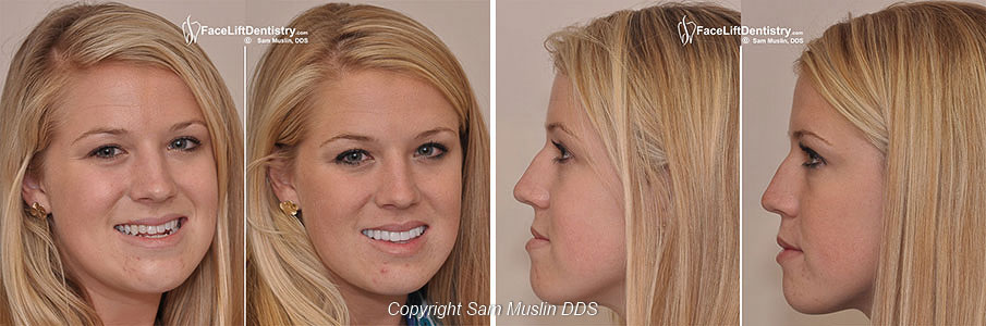 Under Bite Correction Before After photos of a patient who had Under Bite Correction with No Surgery and No Braces in under two weeks.