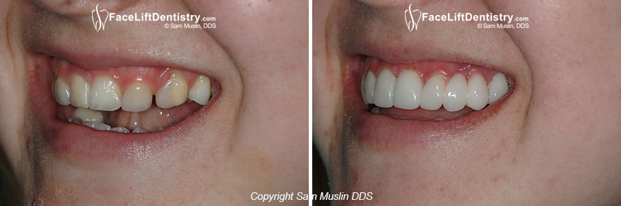 Previous Orthodontics and Dental Bonding Failed to Correct her Underbite