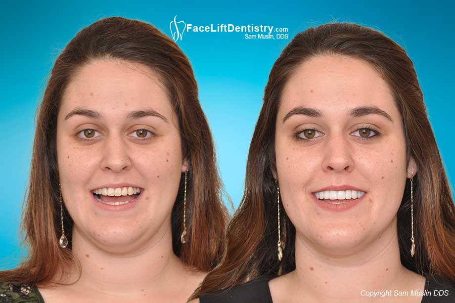Lower jaw moved back for the correct underbite position, without surgery - before and after photo