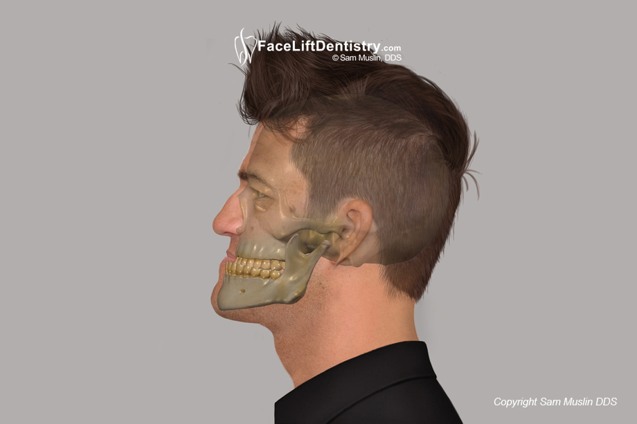 Class iii Underbite Illustration showing a Class iii underbite