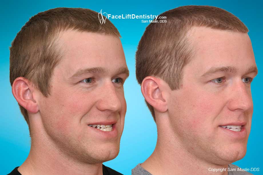  This before-after photo shows the outcome of non-surgical under bite treatment. 