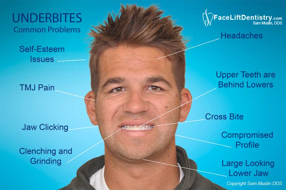 Underbite Problems Fixed Without Surgery