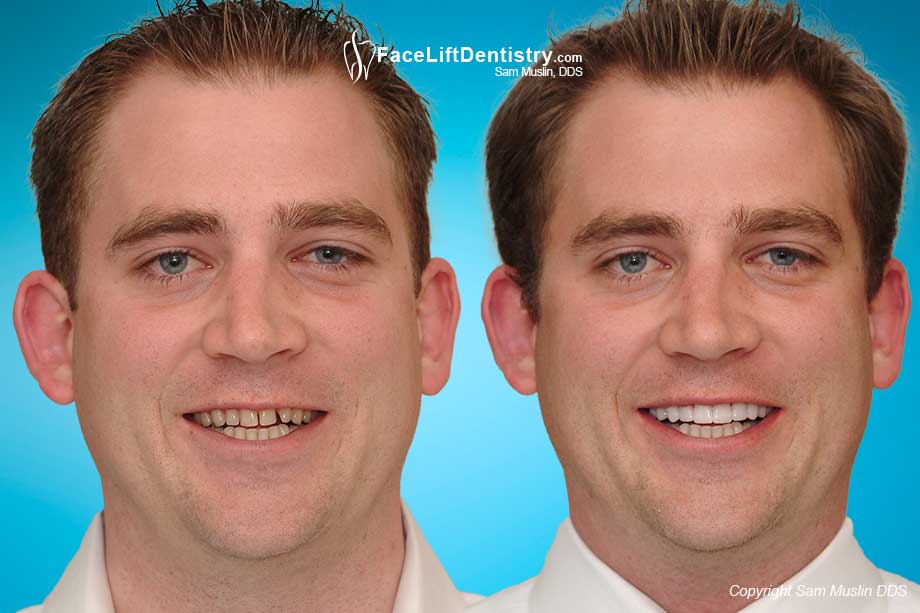  Uneven spaces between teeth before and after treatment