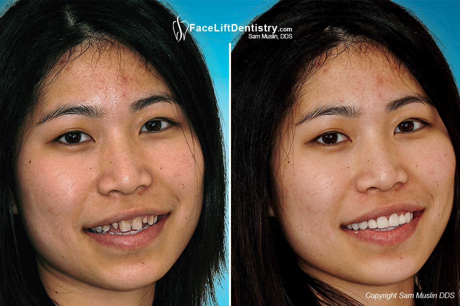  Tetracycline Stains and uneven teeth were corrected with porcelain veneers requiring no grinding.